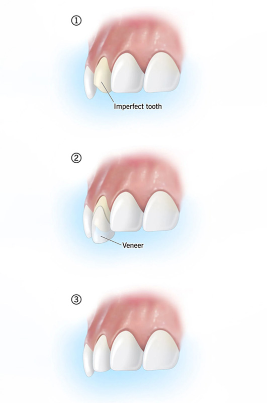 ونیر های لمینت دندان