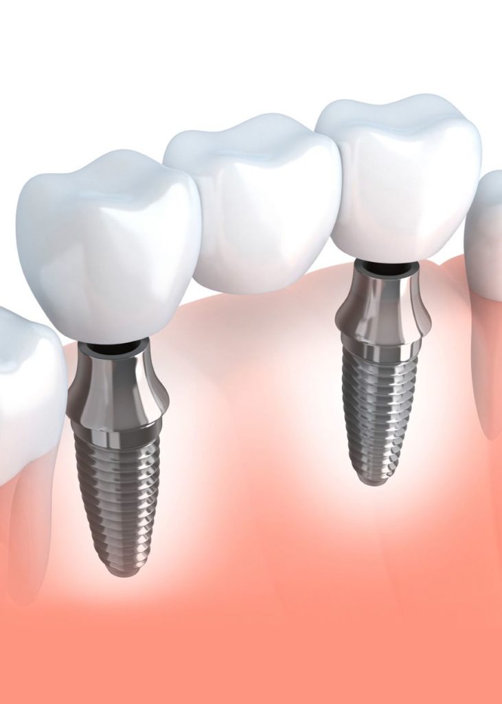 بریج دندان بر پایه ایمپلنت