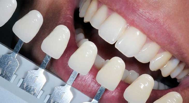 آیا کامپوزیت باعث پوسیدگی دندان میشود؟