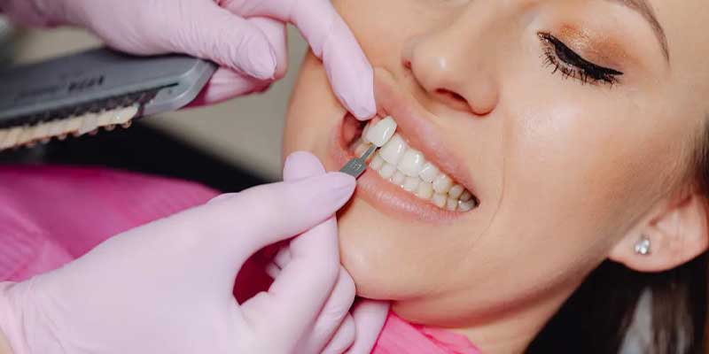 آیا لمینت باعث پوسیدگی دندان می شود؟
