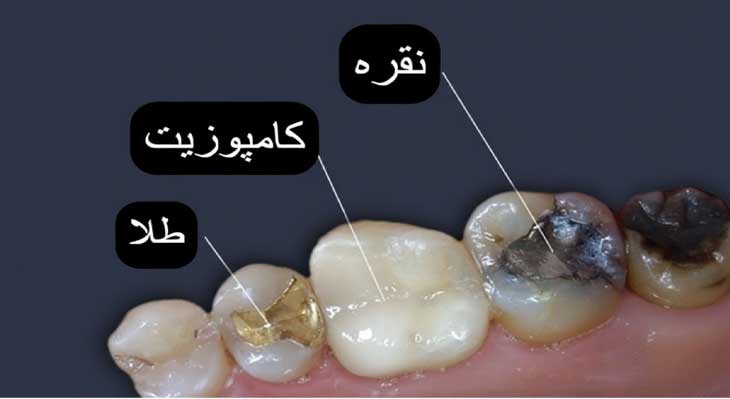 پر کردن دندان