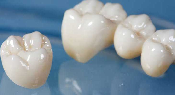 روکش دندان زیرکونیوم