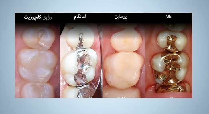 پر کردن دندان