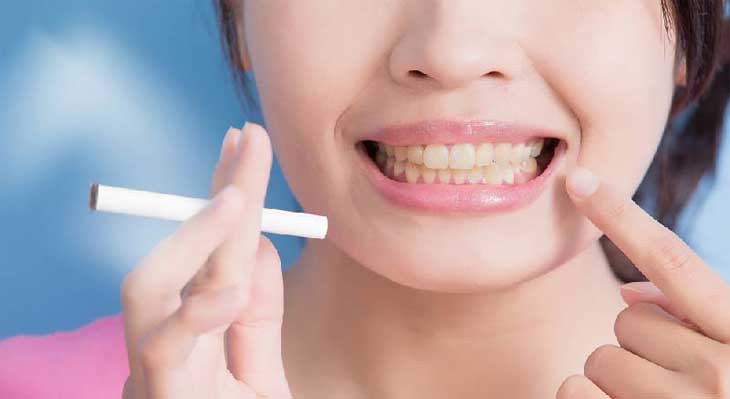 تغییر رنگ لمینت دندان