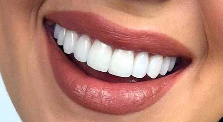 برداشتن کامپوزیت از روی دندان