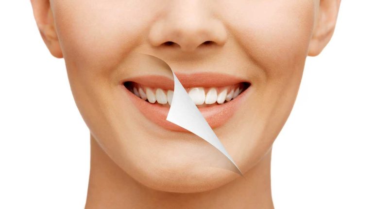 تفاوت جرم گیری و بلیچینگ دندان