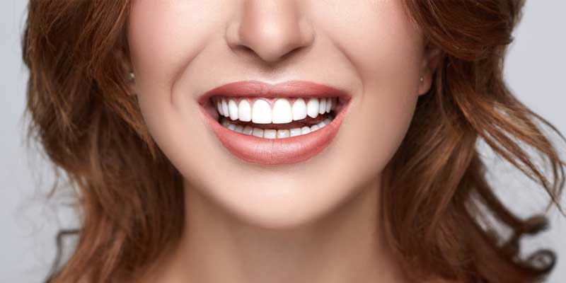 اشتباهات رایج بعد از لمینت دندان
