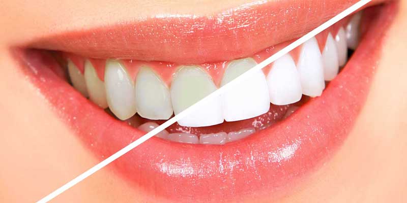 تفاوت جرم گیری و بلیچینگ دندان