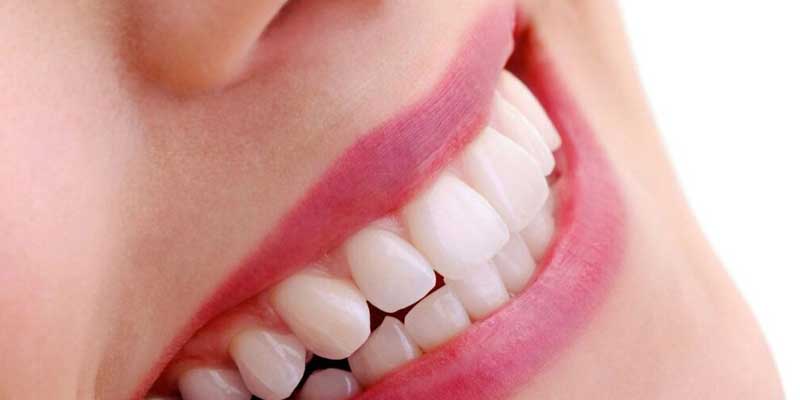 تفاوت جرم گیری و بلیچینگ دندان