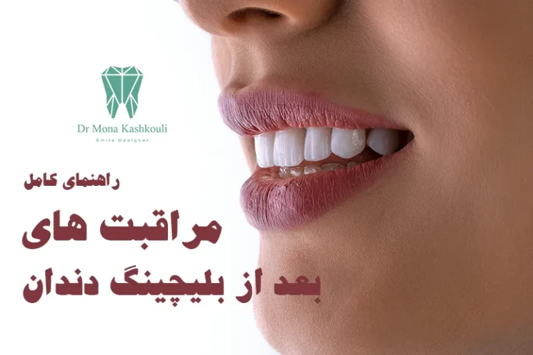 مراقبت بعد از بلیچینگ دندان